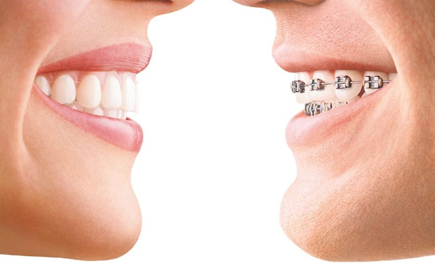 braces-advantages