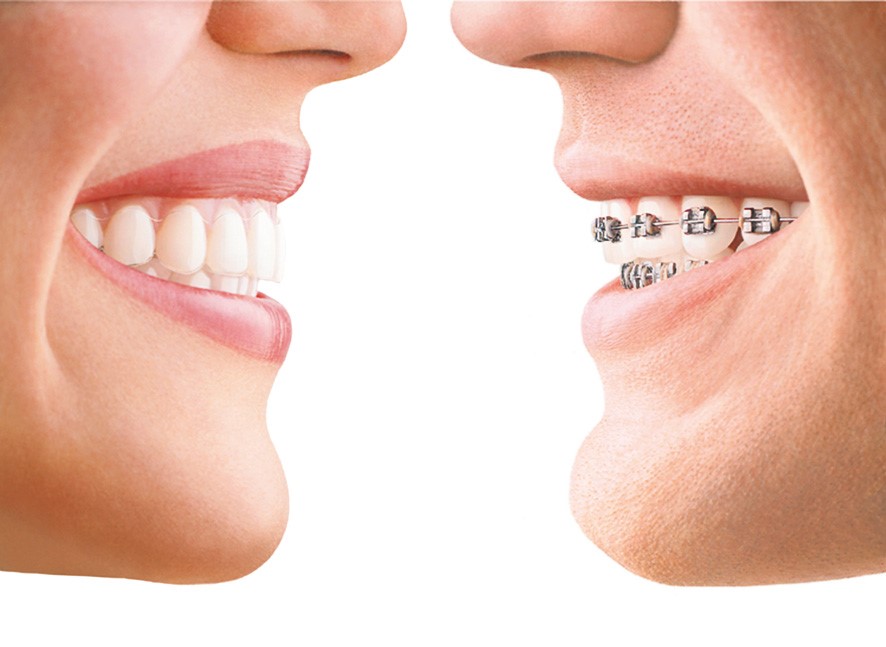 braces-advantages