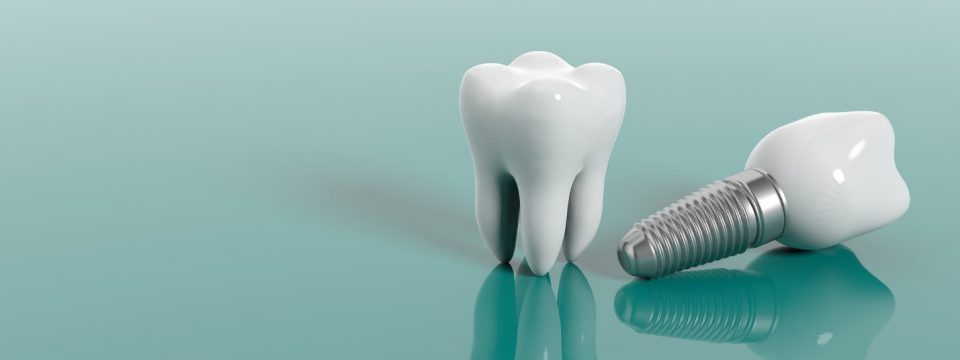 Do You Need Dental Implants After a Root Canal