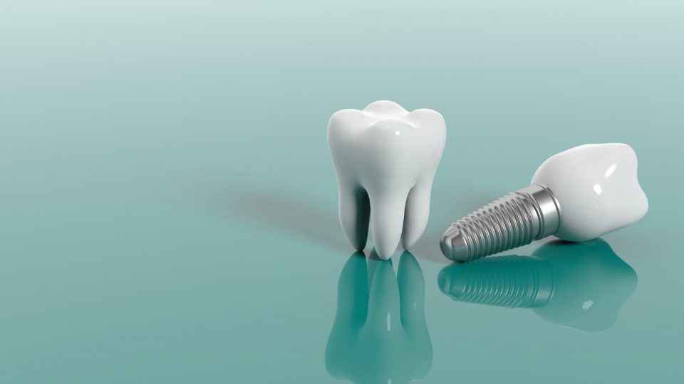 Do You Need Dental Implants After a Root Canal